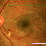 Rétinopathie diabétique modérée